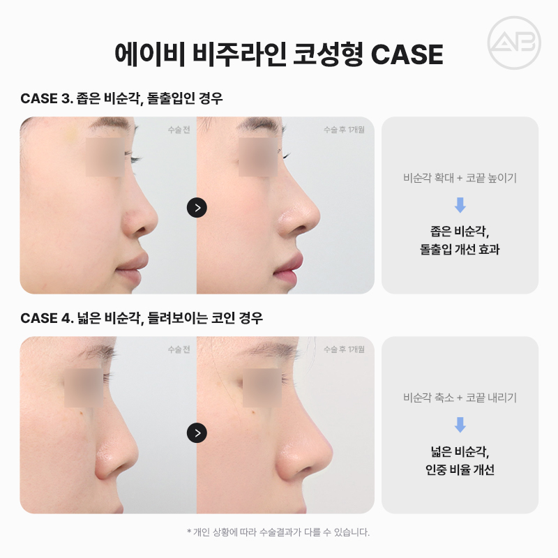 자려한비주라인코성형 AB성형외과에서 완성해보세요 관련 이미지 5