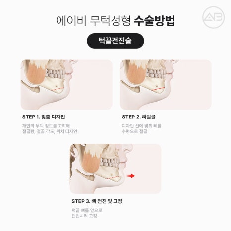 무턱성형 고려하고 있다면 AB성형외과 관련 이미지 3