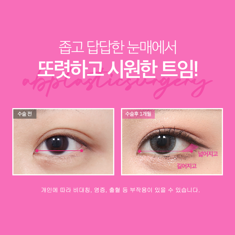 [칼럼] 앞트임을 하면 효과를 많이 볼 수 있을까? 관련 이미지 4