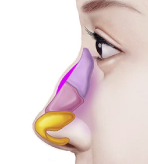 Q. Is it possible to have your first nose surgery without an implant? image 2