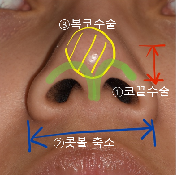 Q. Nose tip surgery, alar reduction, and bulbous nose surgery all look similar. Are they different surgeries? image 1