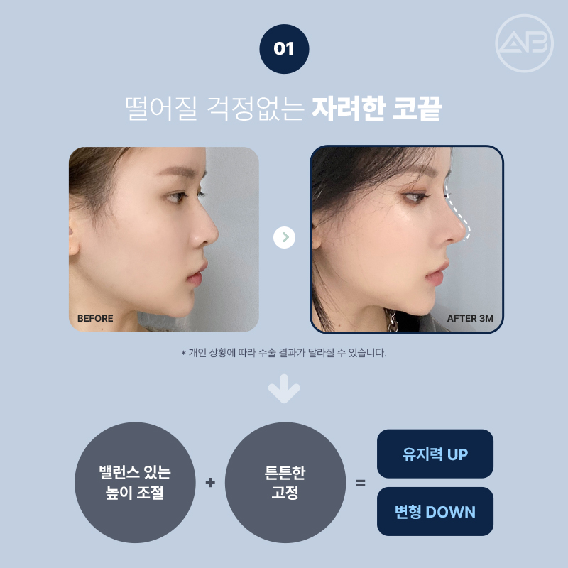 에이비성형외과 자려한코성형 비주라인개선 후기 관련 이미지 3