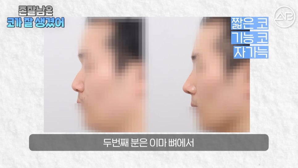 #AB Plastic Surgery #AB TV #Male Nose Surgery #Nose Surgery image 11