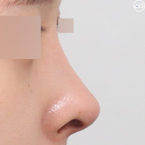 뭉툭한 복코성형, 에이비성형외과 케이스리뷰 관련 이미지 5