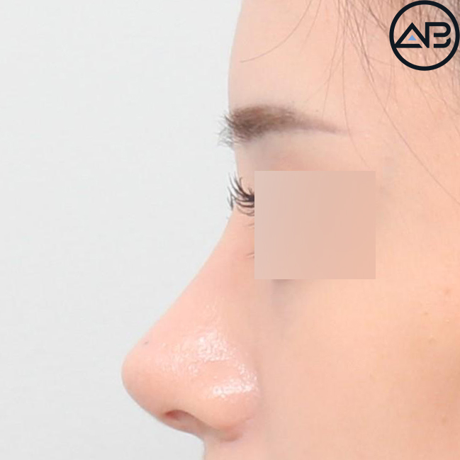 AB Plastic Surgery Refined Rhinoplasty - Revision Surgery Case Review image 8