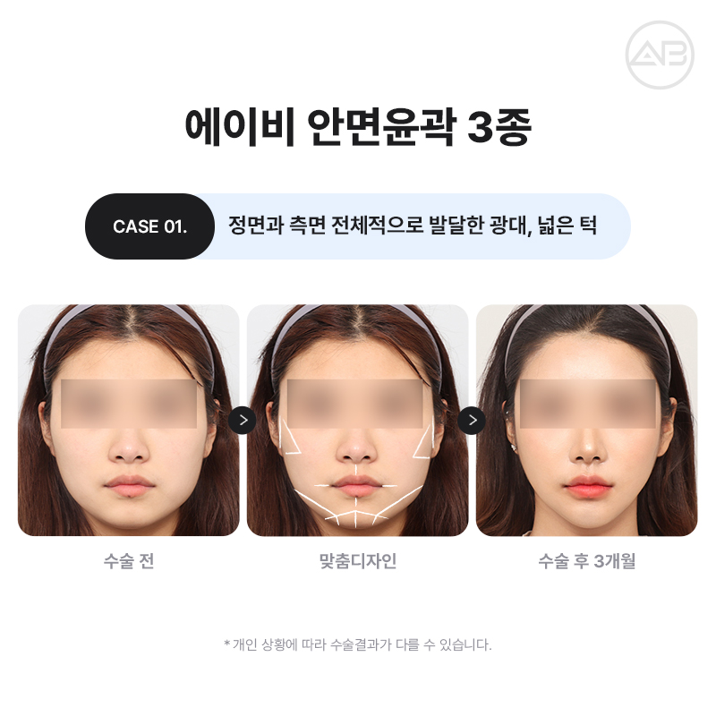 자연스럽고 조화로운 자려한안면윤곽을 원한다면 AB성형외과 관련 이미지 2