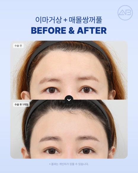 에이비성형외과 눈꺼풀처짐을 바꾸는 이마거상수술의 역할 알아보기 관련 이미지 5