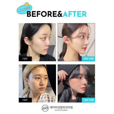 At AB Plastic Surgery, where there is extensive experience with autologous rib cartilage rhinoplasty image 5