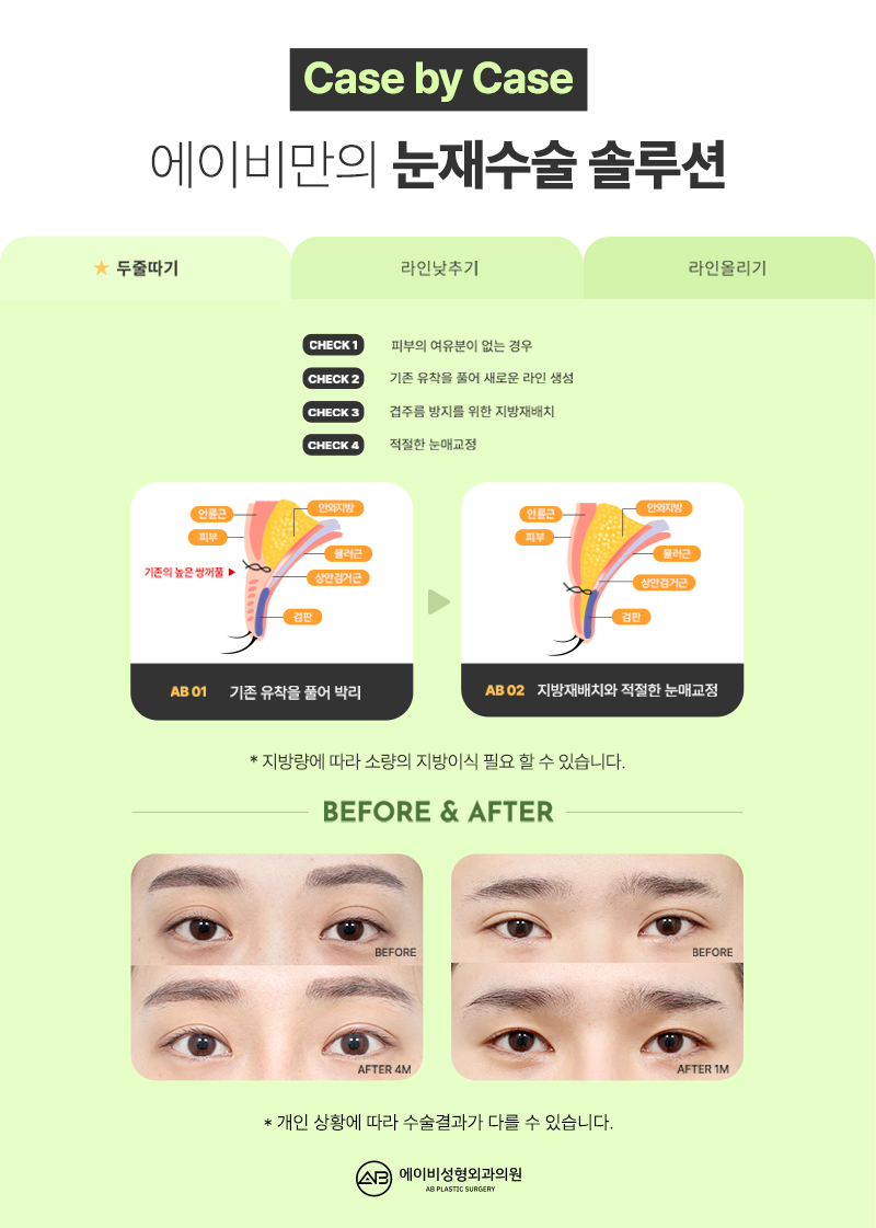 AB Revision Double Eyelid Surgery: What Is Double Folding? image 3