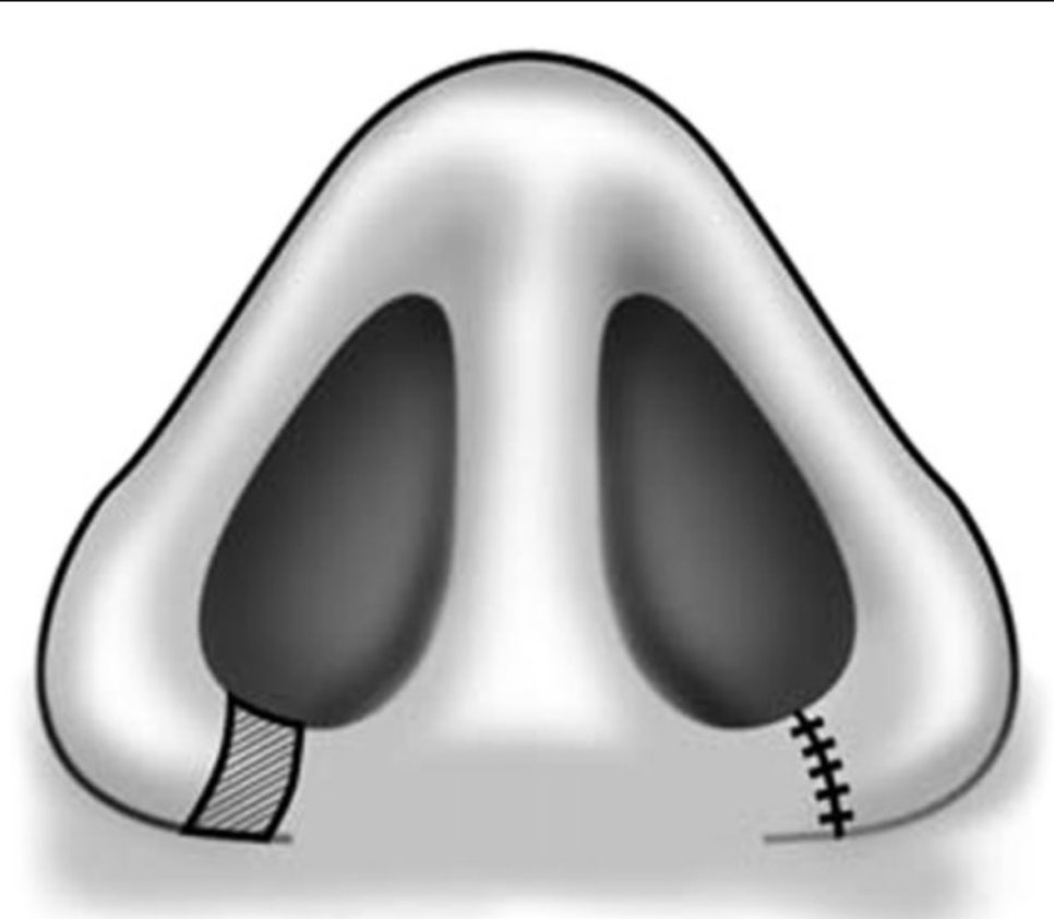 Q. I only want to have alar reduction, but the medial and lateral incision methods seem different. What exactly is the difference? image 3