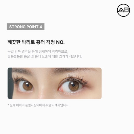 AB Plastic Surgery Under-Eye Fat Repositioning: Effects on Dark Circles and Hollow Under-Eyes, Before-and-After Results, and Side Effects image 7