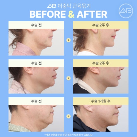 The Secret to a Slim Jawline, AB Plastic Surgery Double Chin Muscle Binding image 7