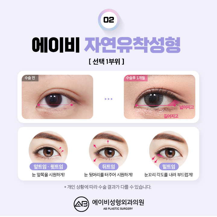 쌍꺼풀수술전후 새로운 결과를 관련 이미지 4