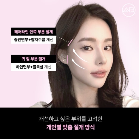 The Secret to Looking 10 Years Younger: AB Plastic Surgery Quick Mini Lift image 5