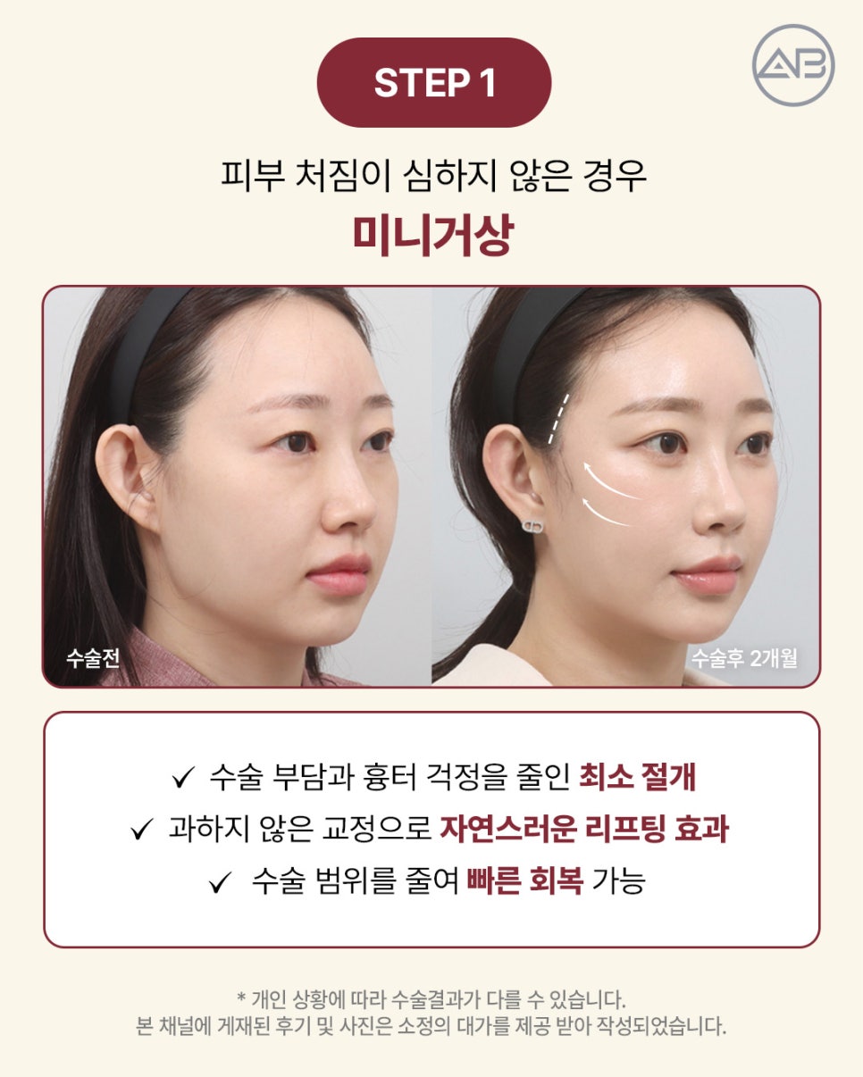 AB Plastic Surgery: Aging-Specific Step-by-Step Lifting (Mini Lift, Semi-Full Lift, Full SMAS Facelift) image 2