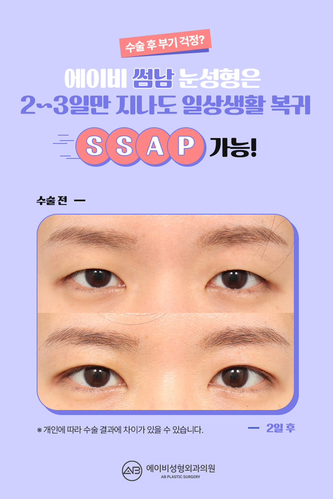 에이비성형외과 썸남눈성형 이게 뭔데? 관련 이미지 8