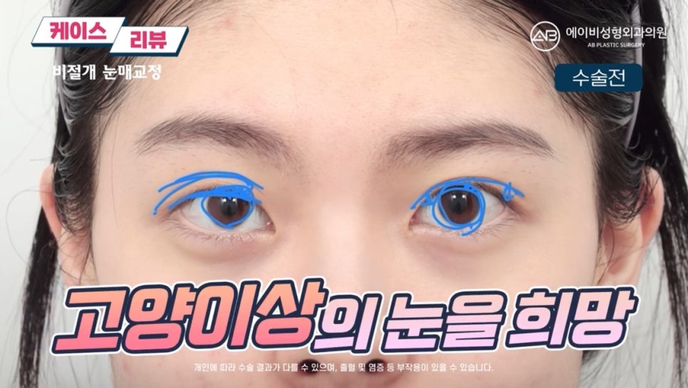 #AB Plastic Surgery #AB TV #Eye Surgery #Non-Incisional Ptosis Correction image 3
