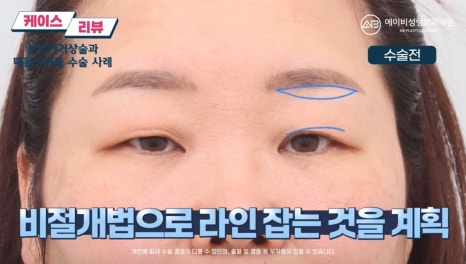 #에이비성형외과#에이비tv#케이스리뷰#중년눈성형 관련 이미지 5
