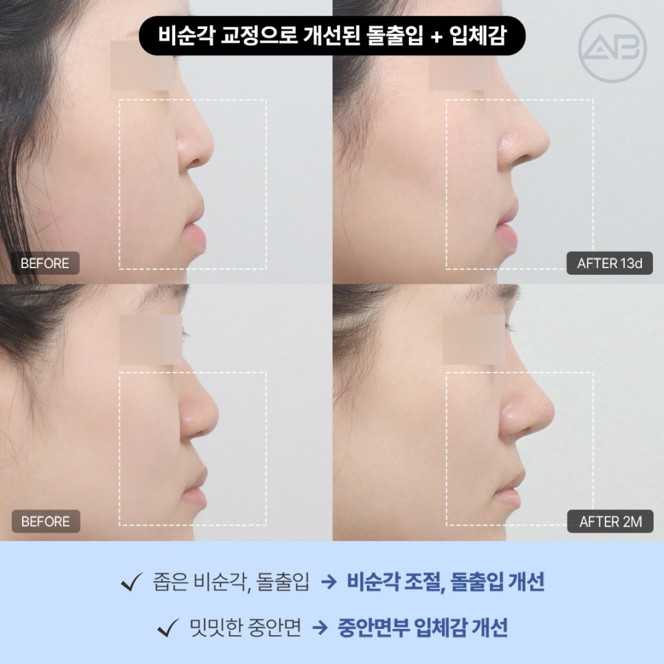 에이비성형외과 코끝수술전후 비주라인과 비순각교정수술이 중요한 이유 관련 이미지 4