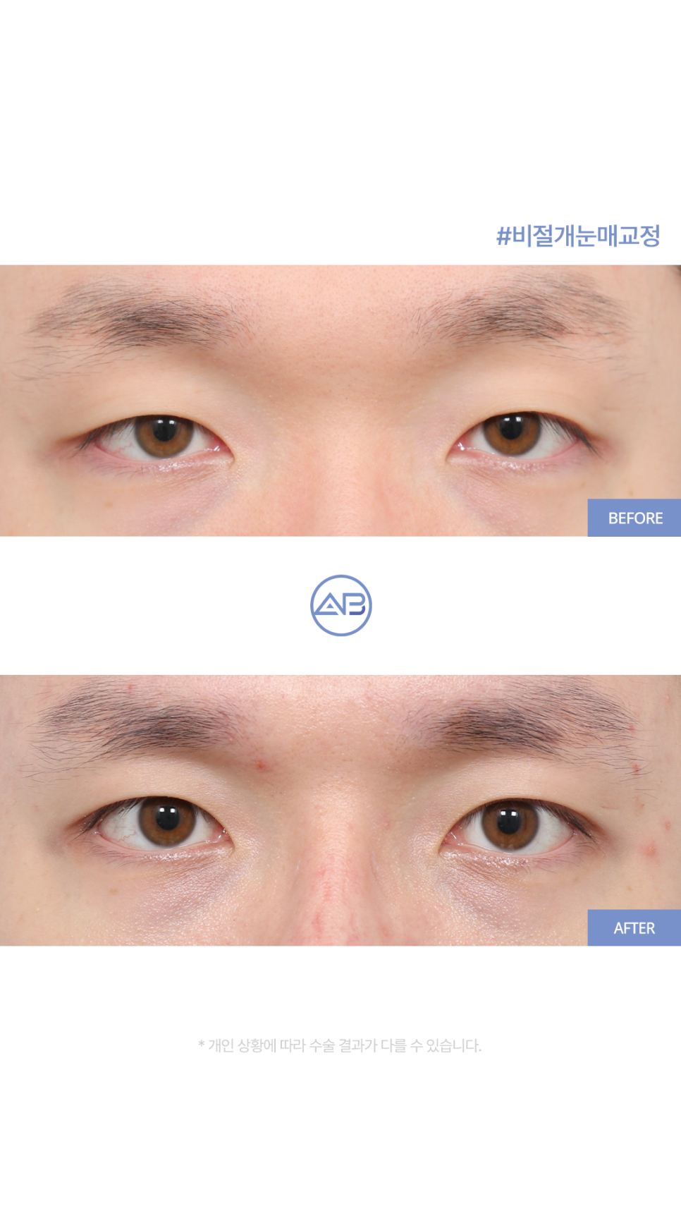AB성형외과 남자눈매교정 수술전후 관련 이미지 4