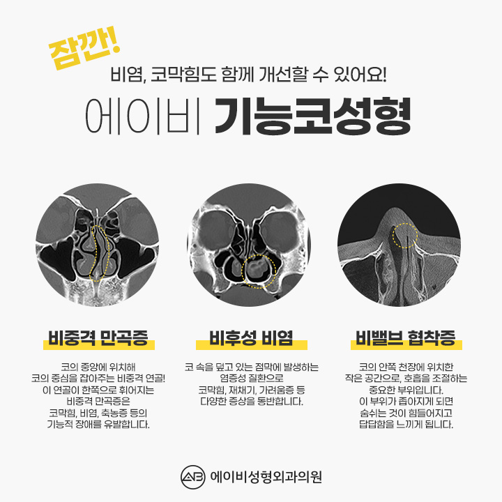 기능코성형 실비 제대로 알고 받기 관련 이미지 2