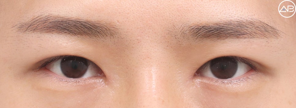 AB Plastic Surgery Male Eye Surgery Case Review (Feat. Director Ahn Moon-young) image 3