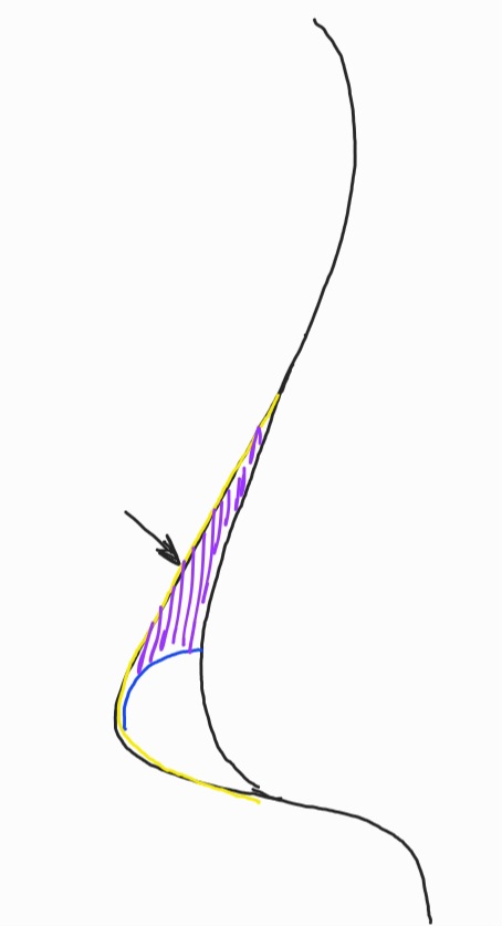 Q. I don’t have much of a nasal bridge, but I want to have only the tip of my nose operated on without an implant. Is that possible? If I have surgery without an implant, how is it performed? image 4