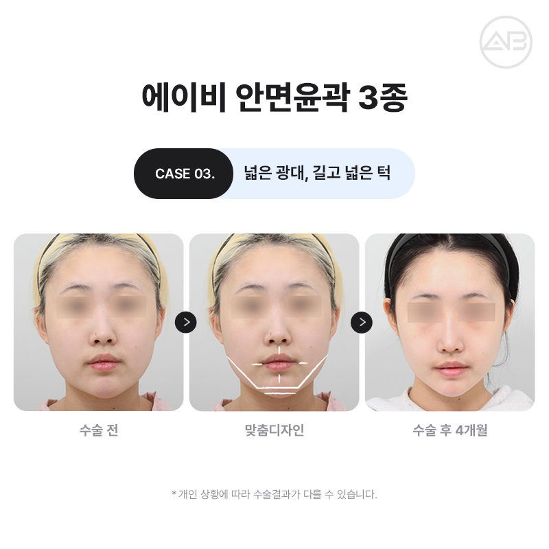 자연스럽고 조화로운 자려한안면윤곽을 원한다면 AB성형외과 관련 이미지 4