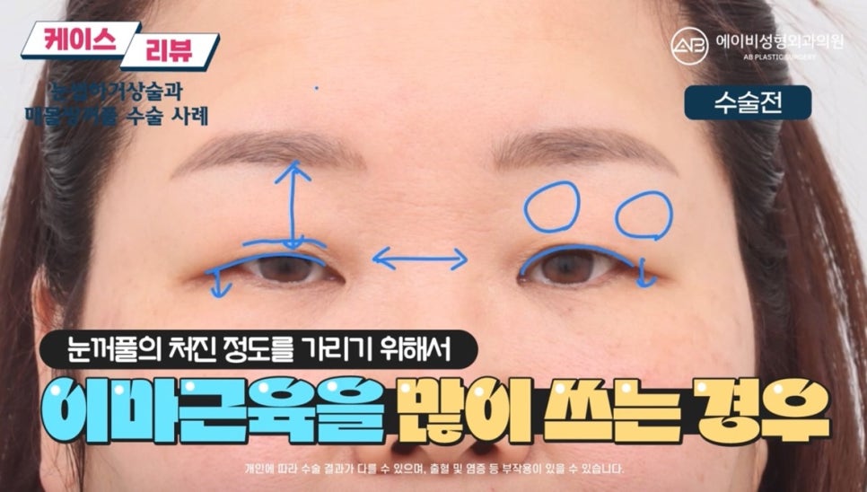 #에이비성형외과#에이비tv#케이스리뷰#중년눈성형 관련 이미지 2
