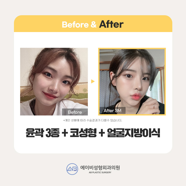 쌍꺼풀수술가격 꼼꼼하게 비교하기 관련 이미지 3