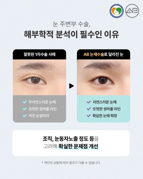 에이비성형외과 눈성형연구회에서 관련 이미지 5