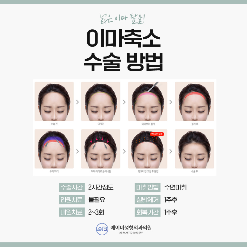 이마축소술후기 만족스럽게 관련 이미지 3