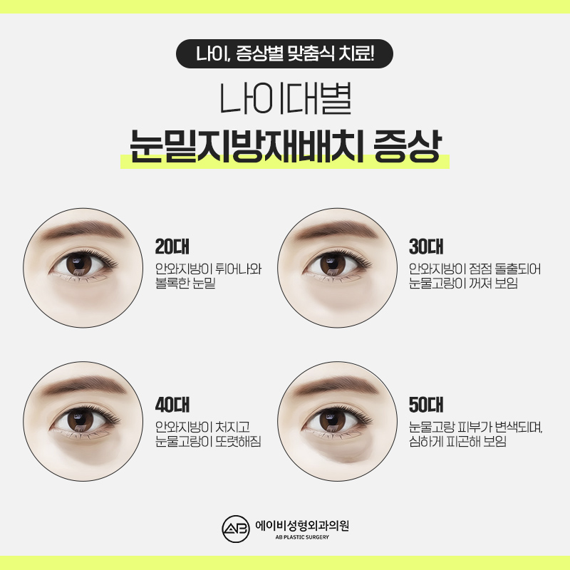 눈밑지방재배치수술 제대로 알고하자 관련 이미지 2