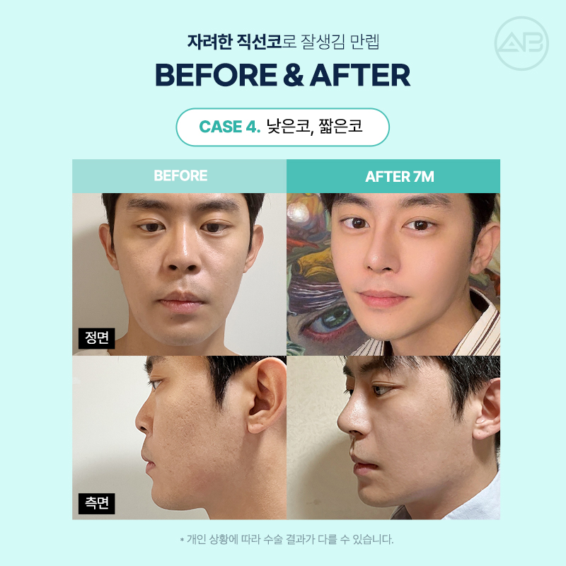 남자직선코성형 왜 에이비성형외과일까? 관련 이미지 13