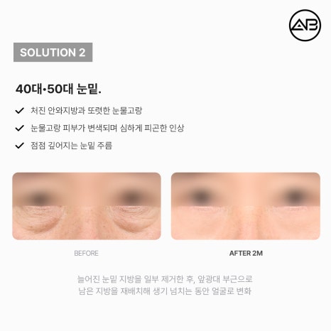 AB Plastic Surgery Under-Eye Fat Repositioning: Effects on Dark Circles and Hollow Under-Eyes, Before-and-After Results, and Side Effects image 9