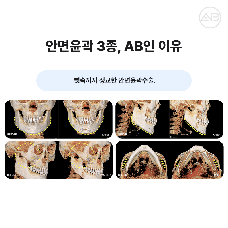 자연스럽고 조화로운 자려한안면윤곽을 원한다면 AB성형외과 관련 이미지 12