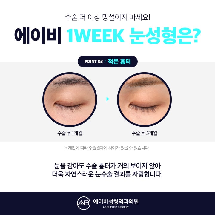 남자눈성형후기 AB성형외과는 남달라 관련 이미지 3