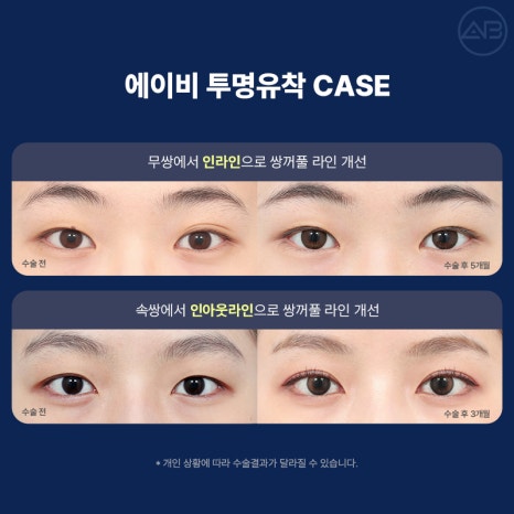 Transparent Adhesion for a Refined Look: AB Plastic Surgery for Attractive Eyes image 8