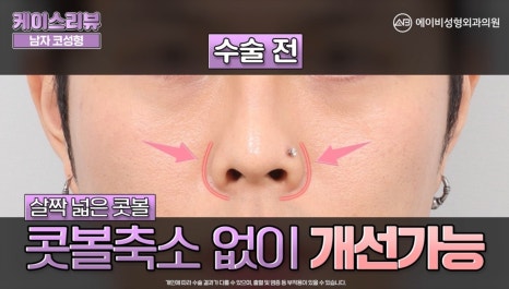 #에이비성형외과#에이비tv#케이스리뷰#남자코성형 관련 이미지 4