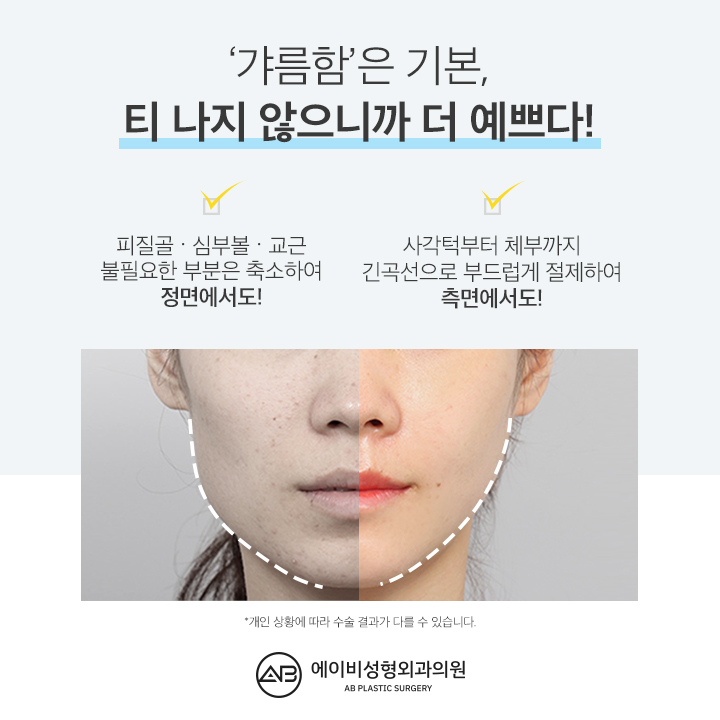 사각턱수술후기 기대가 되지 관련 이미지 5