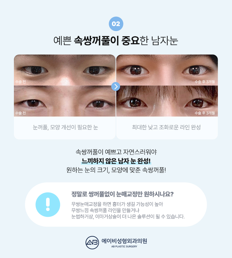 남자눈매교정 잘하는 에이비성형외과 다른점은 뭘까? 관련 이미지 7