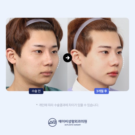 남자 윤곽수술잘하는곳 볼 때 고려해야 할 점 관련 이미지 6