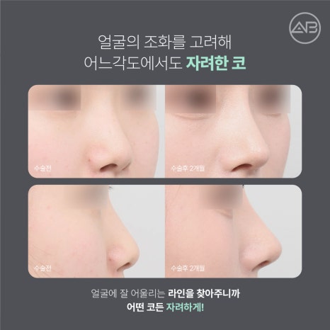 자려한코성형 원한다면 에이비성형외과 관련 이미지 4