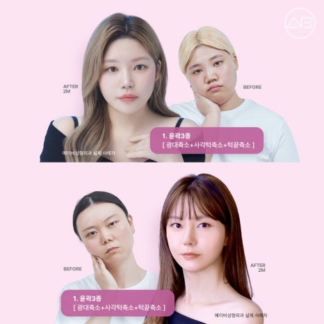 자려한안면윤곽 원한다면 AB성형외과 관련 이미지 16