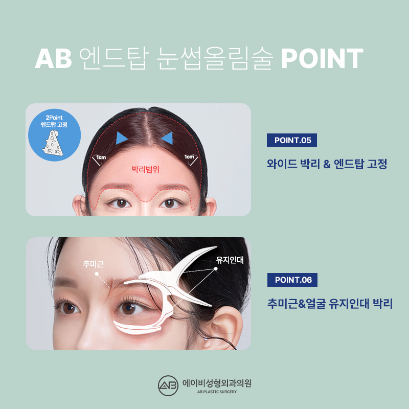 What Is the Endtop Eyebrow Lift That So Many People in Their 20s and 30s Are Getting? image 5