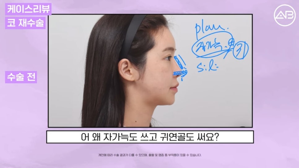 #AB Plastic Surgery #AB TV #Case Review #Nose Surgery #Revision Rhinoplasty image 3