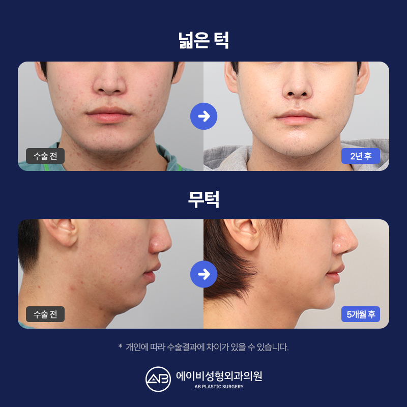 남자 윤곽수술잘하는곳 볼 때 고려해야 할 점 관련 이미지 10