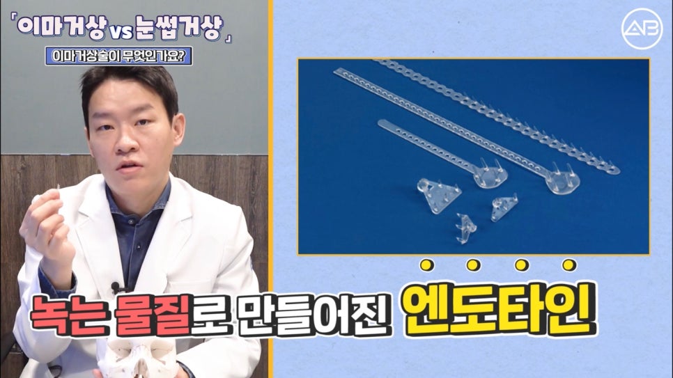#AB Plastic Surgery #AB TV #Forehead Lift #Brow Lift image 3