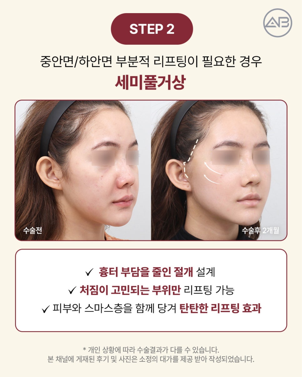 AB Plastic Surgery: Aging-Specific Step-by-Step Lifting (Mini Lift, Semi-Full Lift, Full SMAS Facelift) image 3