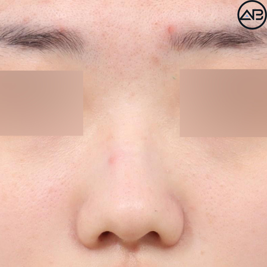 에이비성형외과 자려한코성형 케이스리뷰 관련 이미지 1